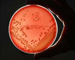 "Siêu vi khuẩn" kháng thuốc đã có tại Việt Nam